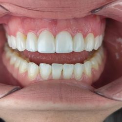 Adentura Clínica Dental | Implantes Y Estética Dental En Zapopan