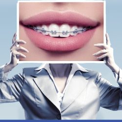 Brackets En Zapotlanejo - Orthoaliner