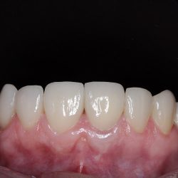 Carillas Dentales En Nezahualcóyotl