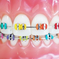 Dental Brackets Sc