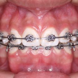 Dental Crown