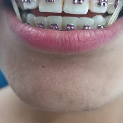 Dental Eugenia