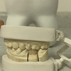Dental Implants Mexico Dentali Dental Care - Dental Implants In Los Algodones Near Yuma Az