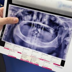 Dental Implants Mexico - Dr Jose Moguel