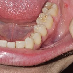 Dental Implants | Texas Dental Clinic | Dentist In Nuevo Progreso