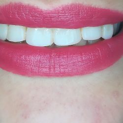 Dental Krysli