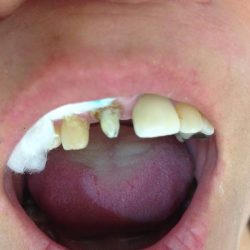 Dental Laser,dr Ismael Alonso