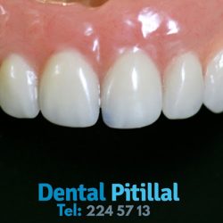 Dental Pitillal