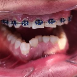 Dental Plata