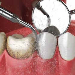 Dental Protect Cancun