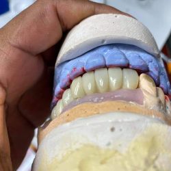Dental Pv, Restauraciones Dentales, Hasta 40 % Mas Barato