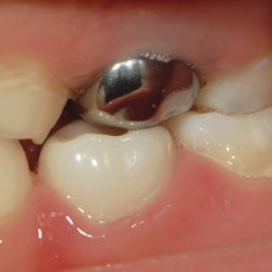 Dental Smile Design