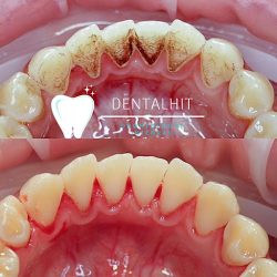 Dentalhit