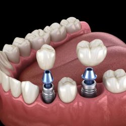 Dentalplus