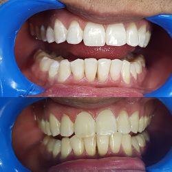 Dentalroli