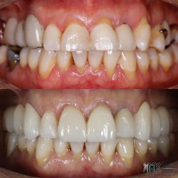 Dentioss