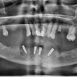 Dentista. Implantes Dentales De Zitacuaro. Dra Elsa Bautista