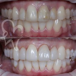 Diseño De Sonrisa En Guadalajara Dra Luly Mata Dentista