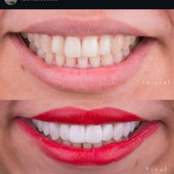 Dr. Jorge Arturo Cuevas - Idental Manzanillo - Diseño De Sonrisa - Carillas Dentales - Dentista - Implantes Dentales -