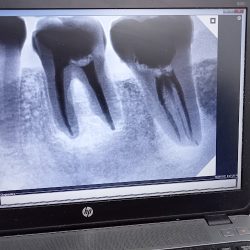 Endo Dental