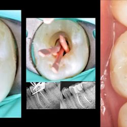 Endodoncia Especializada - Dr Raul Navarro