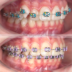 Erodental