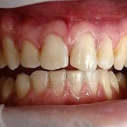 Impladental