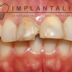 Implantalia