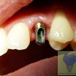 Implantes Dentales En Monterrey Dr Xavier Madrigal