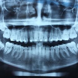 Implantes Dentales | Endodoncia Con Microscopio (microendodoncia)