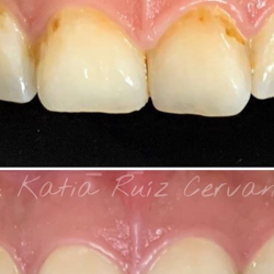 Implantes Dentales Morelia CÉnit Odontología Avanzada | Dentistas En Morelia | Diseño De Sonrisa