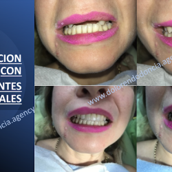 Implantes Dentales ( Una Sonrisa De Perlas Es Posible)
