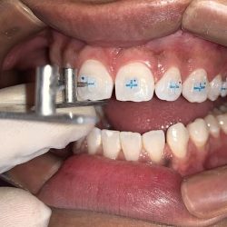 Orthoimplant Doctores Alonso Especialistas Con Maestría Buap.