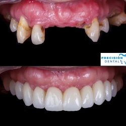 Precisión Dental