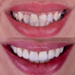 Prostetica Dental Implantes Dentales Ciudad Guzmán