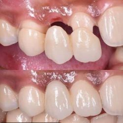Protección Dental