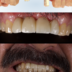 Protesis Bucal E Implantologia. Dr. Alejandro González