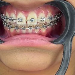 Rehabilitación Dental