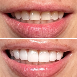 Smile Design Mexico | Diseño De Sonrisas En México | Dr Jemay Zuluaga