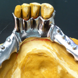 Vaciados Dentales Xalapa