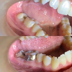 Zero Caries Guerrero